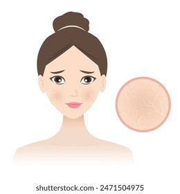 Mujer con Ilustración vectorial facial de piel deshidratada aislada sobre fondo blanco. Manchas secas en la piel, ásperas, escamosas y con picor. Líneas finas en la piel o una tez opaca. Cuidado de la piel y concepto de belleza.