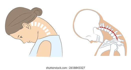 A woman with a drooping neck and her chin touching her chest and her cervical skeleton　Dropped head syndrome