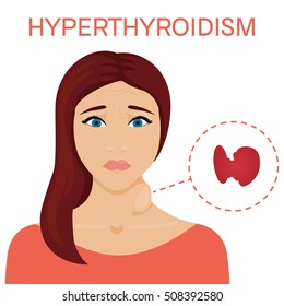 Woman with enlarged hyperthyroid gland. Hyperthyroidism symbol. Patient with a goiter. Medical concept. Anatomy of people. Vector illustration.