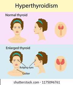 6,315 Hyperthyroid Images, Stock Photos & Vectors | Shutterstock