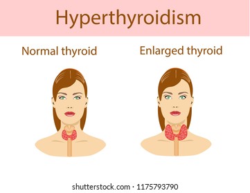 6,315 Hyperthyroid Images, Stock Photos & Vectors | Shutterstock