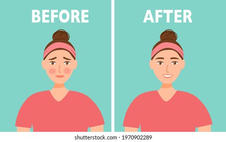 Woman face acne before and after skin care treatment in flat design.