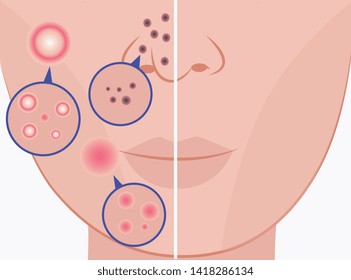 Woman face before and after acne treatment procedures flat cartoon vector icons illustration isolated on white background. Comparison of healthy and problem skin.