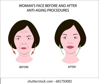 Woman face before and after anti-aging procedures