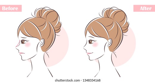 woman face before and after cosmetic nose surgery 