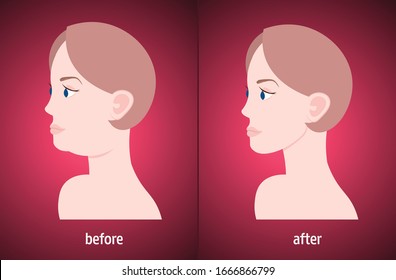 woman face before and after double chin fat correction procedure aesthetic medicine concept horizontal portrait vector illustration