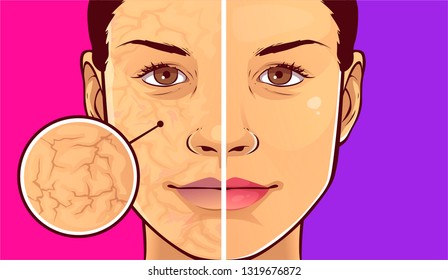 Woman Face With Dry Skin. Before-after. Vector Illustration.