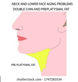 Woman face profile with double chin and preplatysmal fat