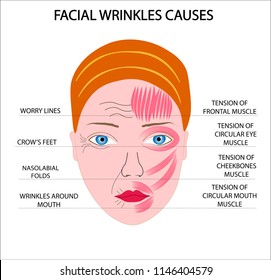 Woman face scheme demonstrating causes of facial wrinkles and folds and ways of correction aging signs