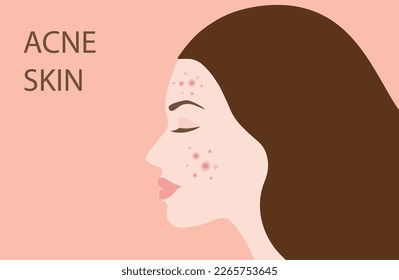 Woman face with skin acne, pimples, blackheads vector illustration. Acne skin face problem concept