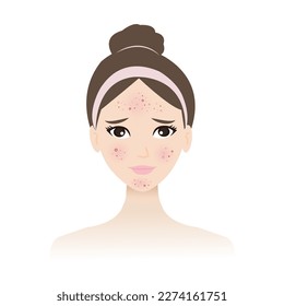 The woman face with skin acne vector isolated on white background. Acne, pimples, blackheads, comedones, whiteheads, papule, pustule, nodule and cyst on face. Skin face problem concept illustration.