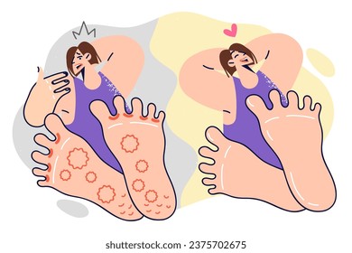 Woman with foot fungus before and after using medicinal ointment or seeing doctor. Girl who has recovered from foot fungus or allergic rash experiences happiness and relief thanks to medications