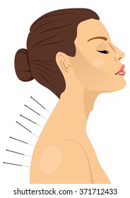woman getting an acupuncture treatment