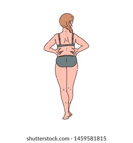 Woman or girl with a slight excess weight squeezing fat on the back sketch vector illustration isolated on white background. Surgery and subcutaneous fat breakdown.