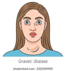 Woman with Graves' disease toxic diffuse goiter diagram schematic vector illustration. Medical science educational illustration