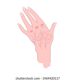 Woman hand with dry skin damaged by cracks - vector isolated illustration