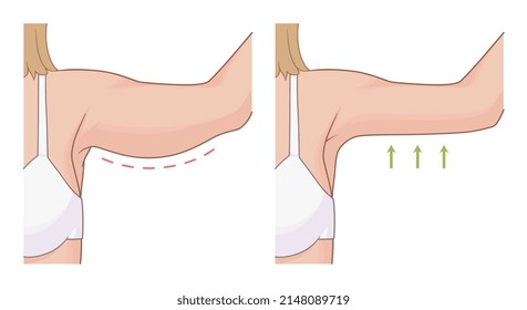 Woman hands fat loss illustration before and after exercises. 