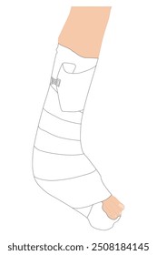 Woman has a broken leg in foot splint or a cast. Ankle injury. Bone and ankle fracture. Orthopedic plaster or fiberglass cast. Vector Medical Illustration.