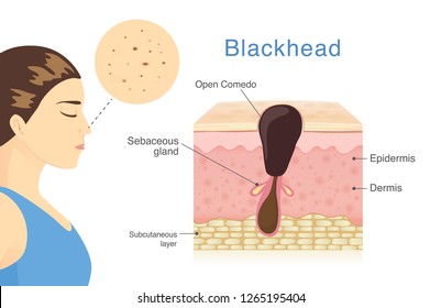 Woman have blackhead acne on her nose with skin layer and description. Illustration about medical diagram.