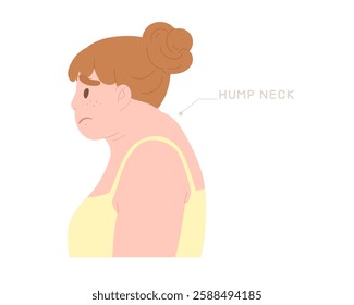 Woman have Hump Neck or Buffalo Hump symptom. Concept of office symdrome, kyphosis, incorrect posture, fat, Cervical Bulging Disc- Neck, spine, health care. Flat vector illustration