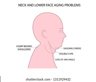 Woman head  demonstrating key problems in lower part of the face and neck