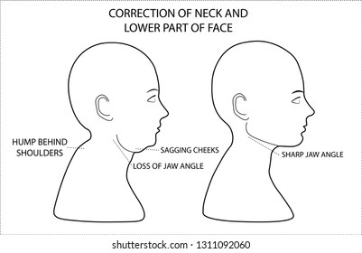 Woman head silhouettes,  demonstrating problems with neck and lower part of the face