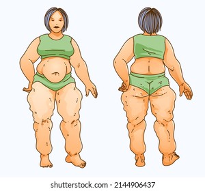 The woman with health problems. Lipedema. Front and back sides of the woman's body. Healthcare illustration, medical infographics. Vector illustration. svg
