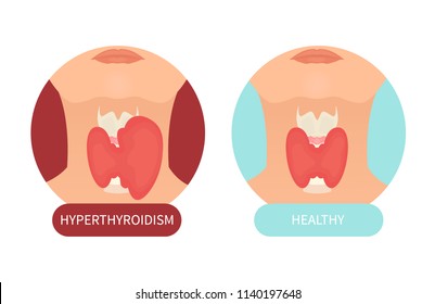 Woman with healthy thyroid gland and hyperthyroidism made in cartoon style. Front view sign. Human body organ anatomy icon. Medical concept. Vector illustration made in cartoon style.