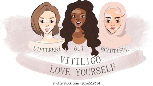 Woman in hijab, black woman and 
 asian woman with vitiligo. World vitiligo day. Body positive and selflove.