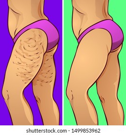 Woman hips with cellulite, vector illustration