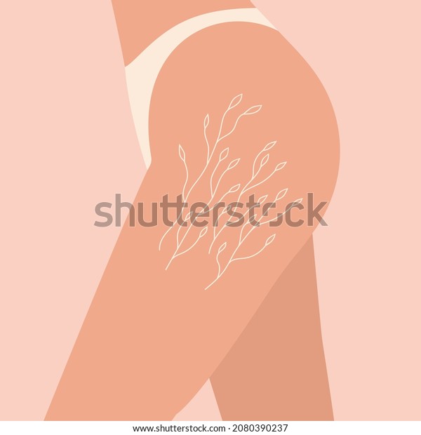Woman hips with stretch marks as branches\
with leaves. Self love and body positive concept. Loss of weight\
aftereffects. Vector llustration in flat\
style