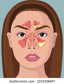 Woman With Illustration Of Paranasal Sinus