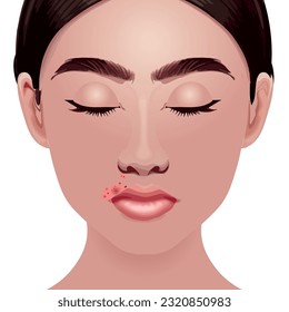 woman with impetigo, a dermatological disease in the mouth region. vector illustration.