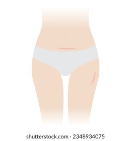 The woman with keloid scars on belly and thigh vector illustration isolated on white background. Keloid scar, raised scar on her body after having a cesarean section, hysterectomy and skin injury.