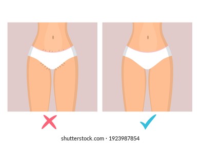 Woman in lingerie with a neglected bikini area. Long hair from under the panties. Two images with depilation before and after and sign yes and no