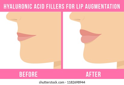 Woman makes procedure of beauty injection for lip augmentation. Lips before and after hyaluronic acid lip filler injection. Vector