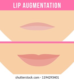 Woman makes procedure of beauty injection for lip augmentation. Lips before and after hyaluronic acid lip filler injection. Vector