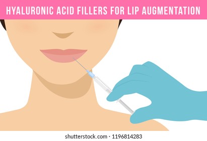 Woman makes procedure of beauty injection for lip augmentation. Hyaluronic acid lip filler injection. Vector