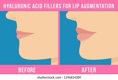 Woman makes procedure of beauty injection for lip augmentation. Lips before and after hyaluronic acid lip filler injection. Vector