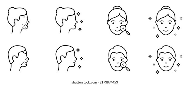 Woman And Man Faces Outline Icon. Pimples On Face, Blackhead, Acne, Rash Line Icon Set. Girl And Boy With Beauty Face. Dermatologic Problem, Allergy, Inflammation Skin. Vector Illustration.