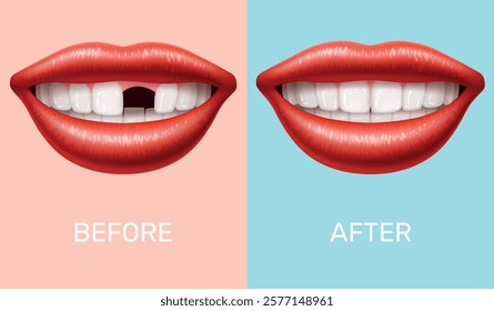 Woman mouth without tooth. Teeth implantation. Realistic woman mouth, smile before and after. Prosthetics in stomatology clinic. Dental medicine, molar 3d isolated vector healthcare concept