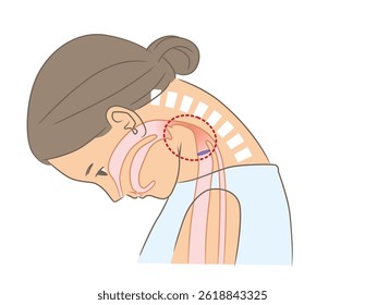 A woman with a narrowed pharynx due to a dropped head syndrome