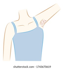 Woman On The Armpit, Red And Jerky, Inflammation