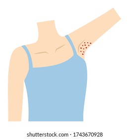 
Woman On The Armpit, Red And Jerky, Inflammation