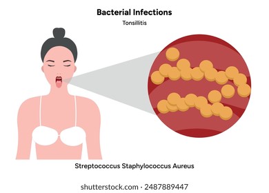 Woman with open mouth and tonsillitis in zoom streptococcus staphylococcus aureus