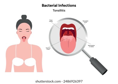 Woman with open mouth, viral bacterial infection, sore throat, tonsillitis, medical diagram zoom