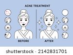 Woman with Pimples on Beautiful Face. Acne Treatment. Skin Problems. Before After. Clean skin and Happy Girl. Icons. Zoom. Flat Cartoon Line style. Vector illustration for Beauty and Medical design.