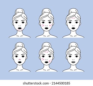 Woman with Pimples on Chin, Cheeks and Forehead. Female Face with Acne. Teenagers with Problem Skin. Healthy skin and Smile. Flat Line Contour style. Black White color. Vector image for Medical Design