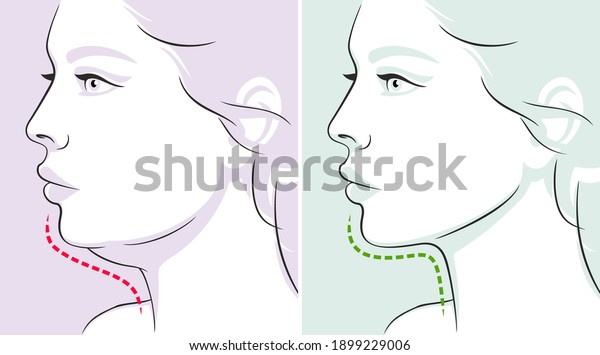Woman profile, double chin, before-after.\
Woman face. Vector\
illustration
