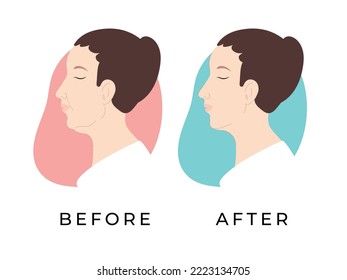 Woman profile. Female face before and after receiving hardware cosmetology procedure. Double chin. Woman face. Vector illustration